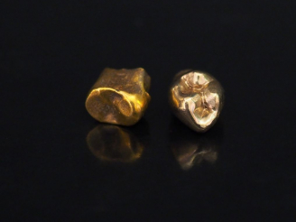 Vente aux enchères Or dentaire.  Poids tel. 6,37 g