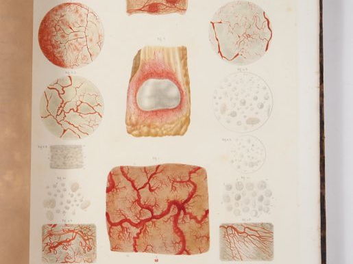 [MÉDECINE]. LEBERT (Hermann). TRAITÉ D’ANATOMIE PATHOLOGIQUE GÉNÉRALE 
