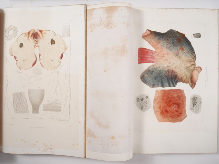 [MÉDECINE]. LEBERT (Hermann). TRAITÉ D’ANATOMIE PATHOLOGIQUE GÉNÉRALE 